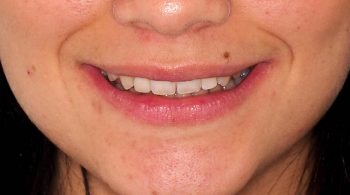 Diseño de su sonrisa