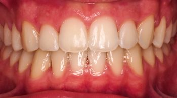 Ortodoncia fija: Maloclusión dental clase II