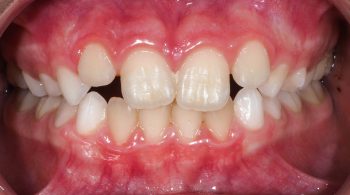 Ortodoncia preventiva: Mordida cruzada