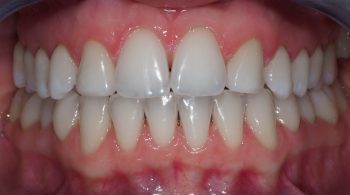 Blanqueamiento: Mejora del tono de su sonrisa