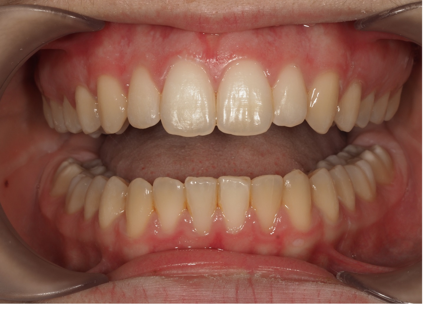 After image