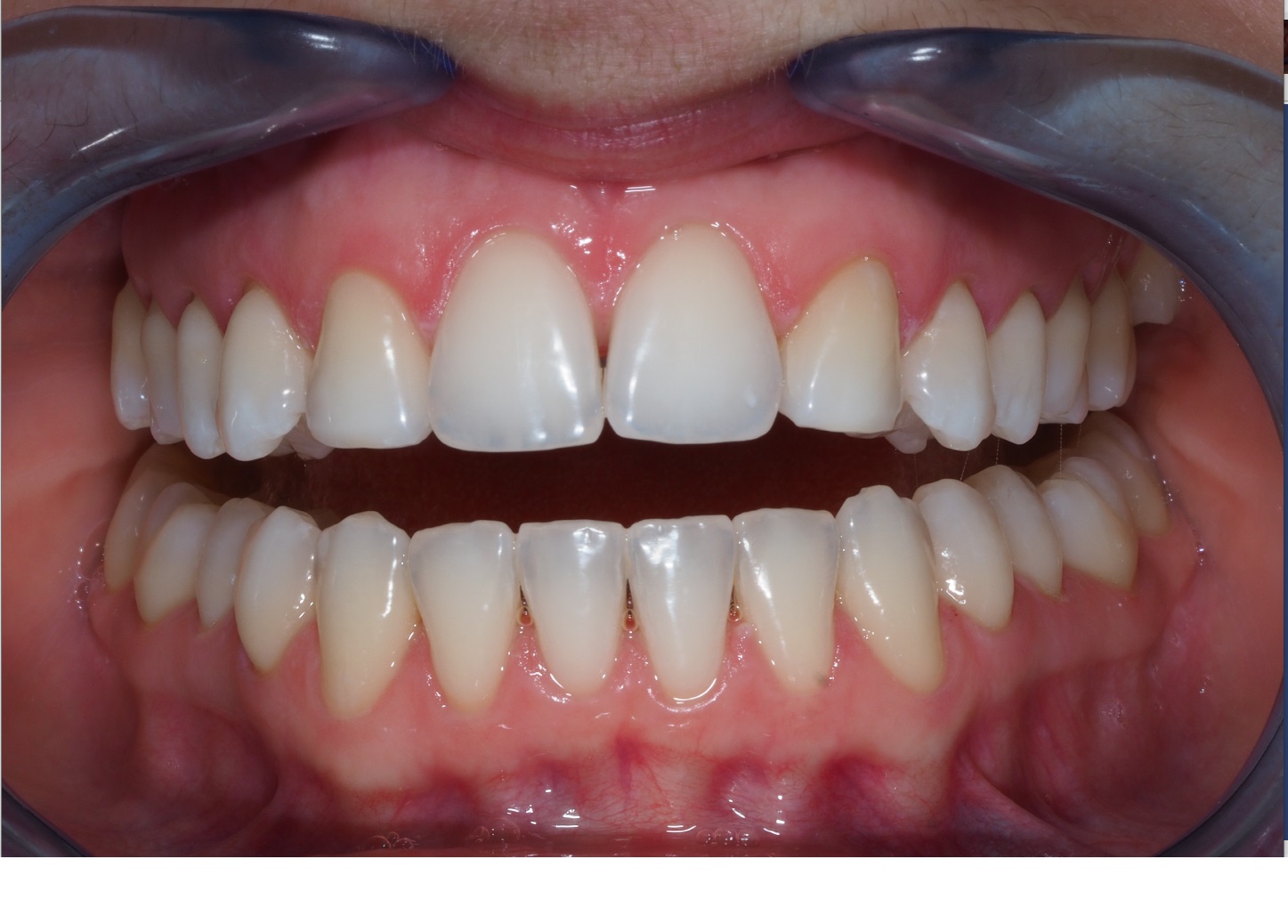 After image