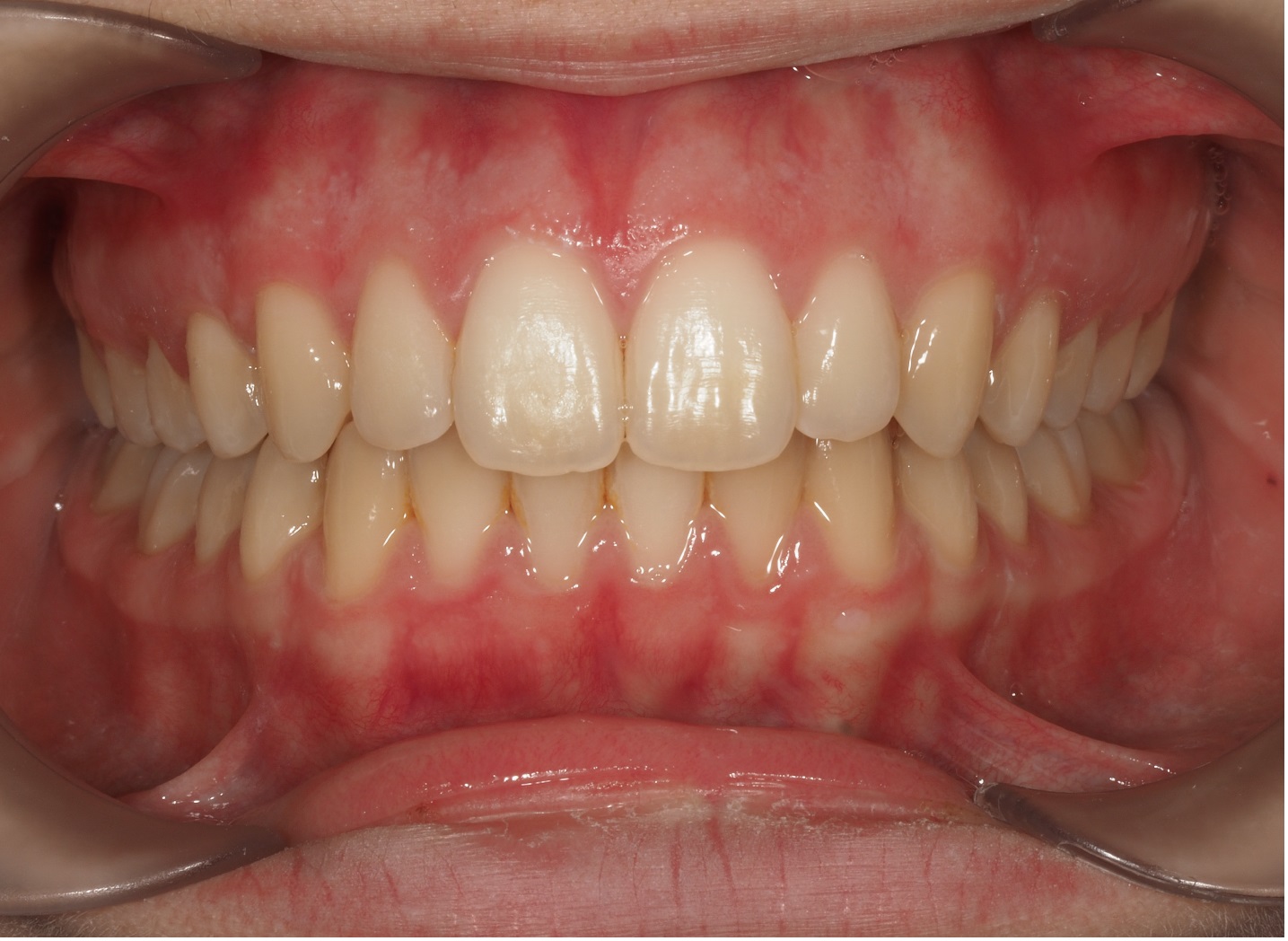 After image