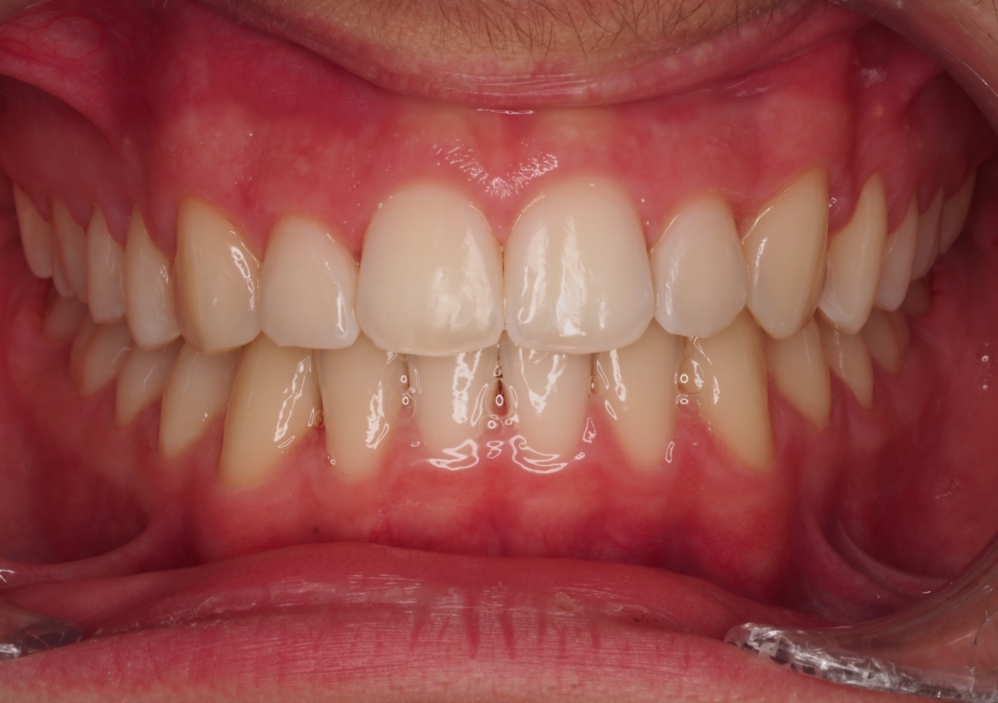 After image