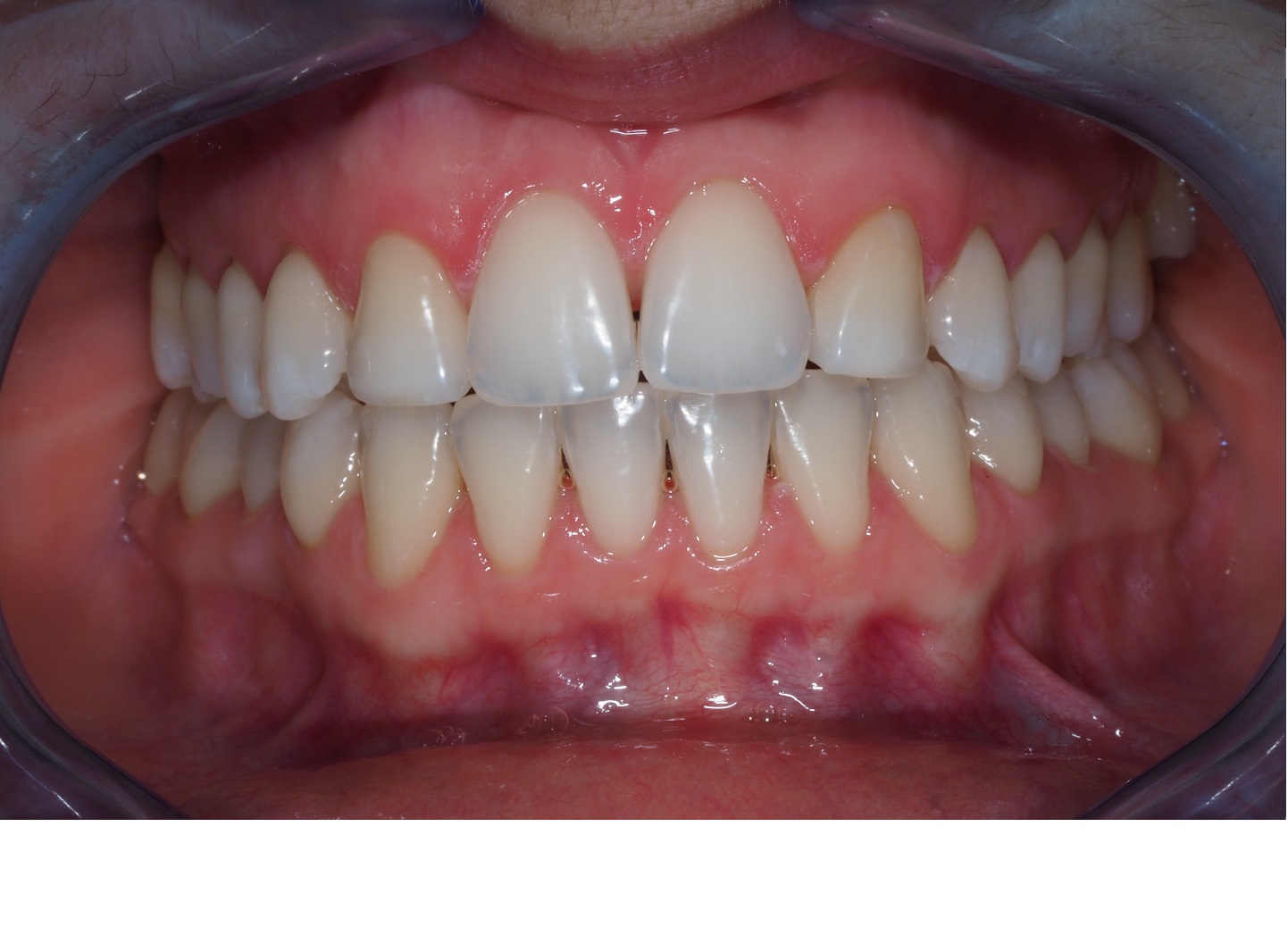 After image