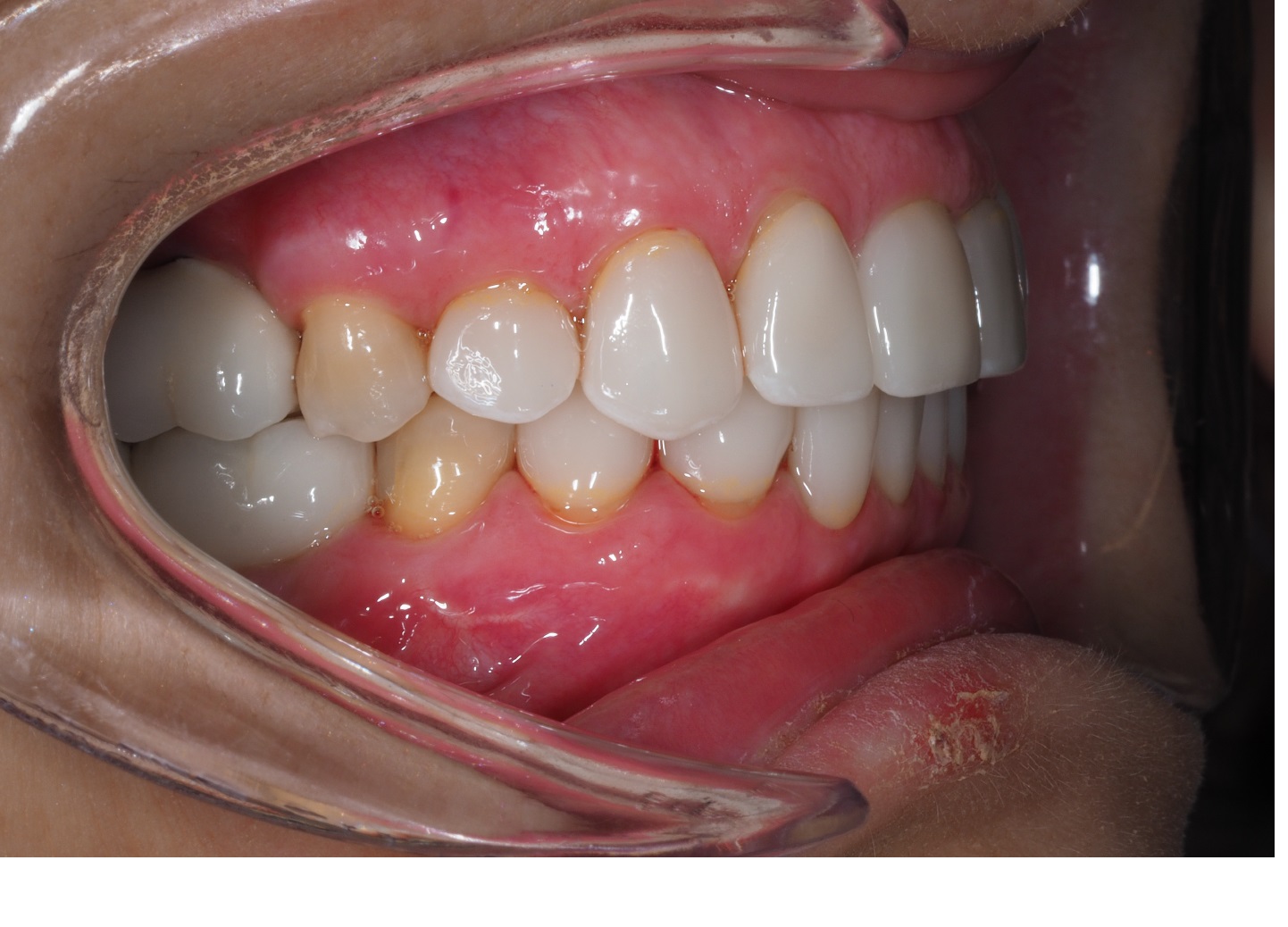 After image