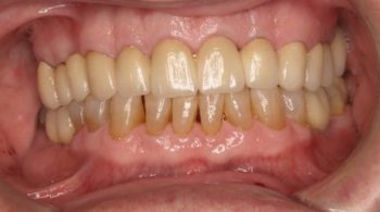 Coronas, implantes y rehabilitación