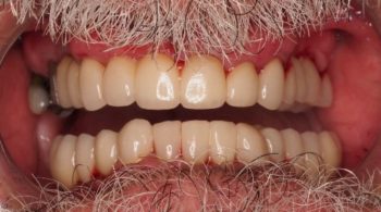 Implantes, puentes y coronas