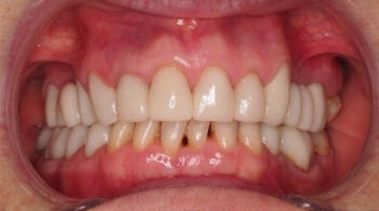 Coronas, puentes y mesoterapia