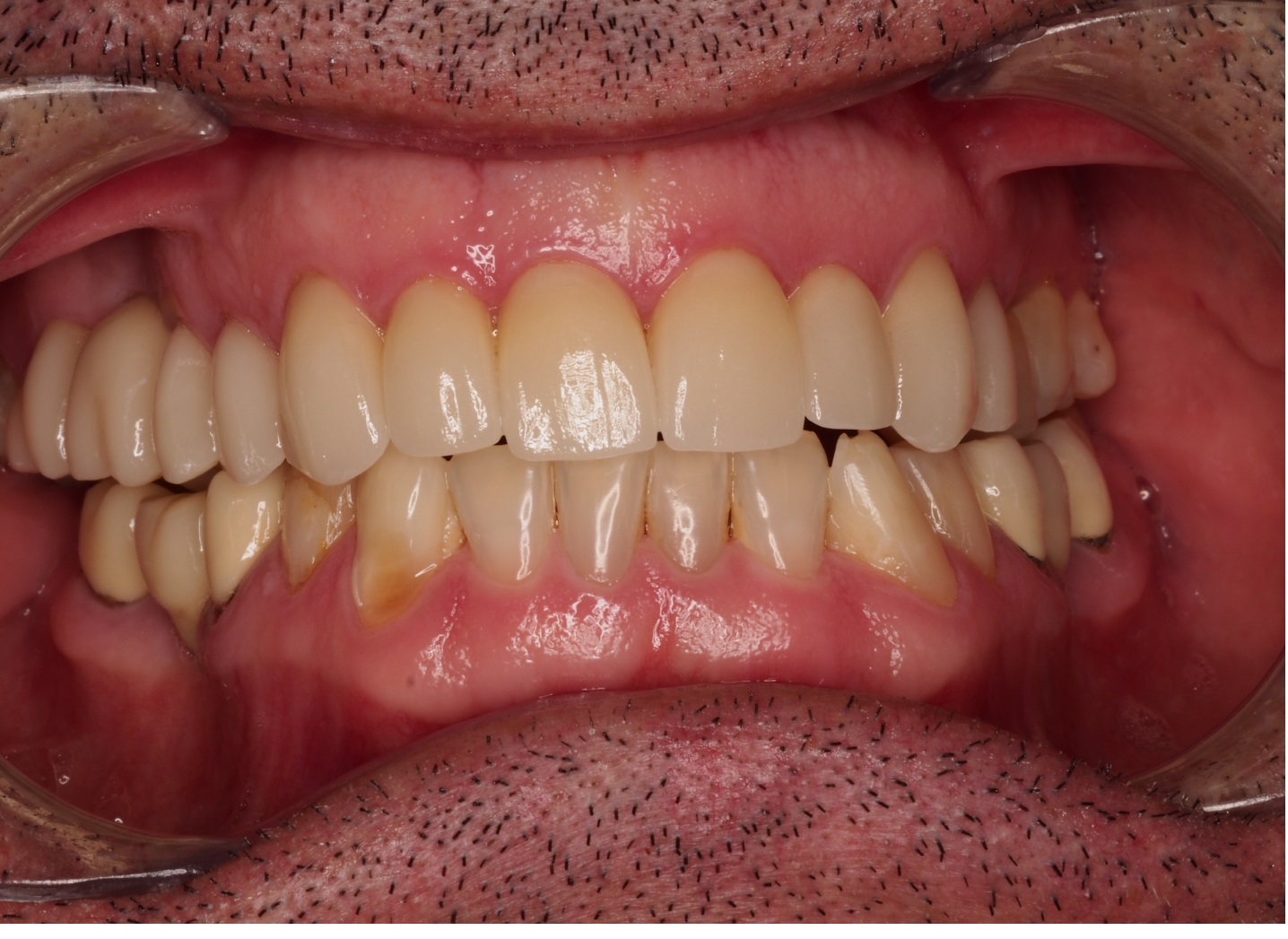 After image