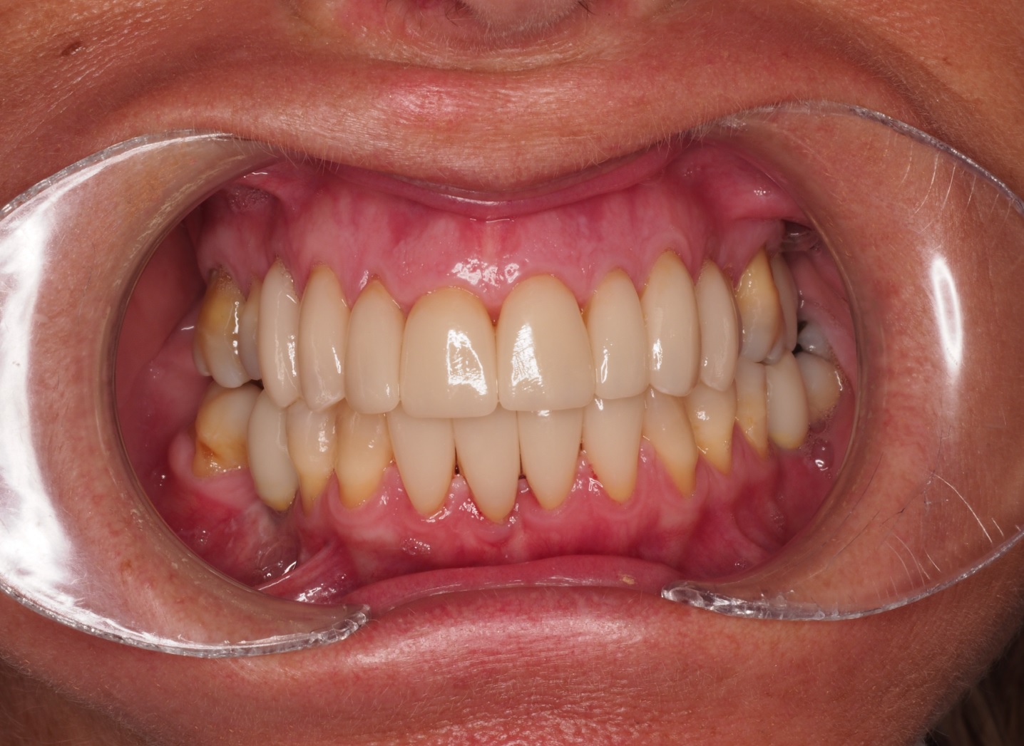 After image