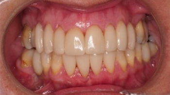 Implantes, carillas y estética