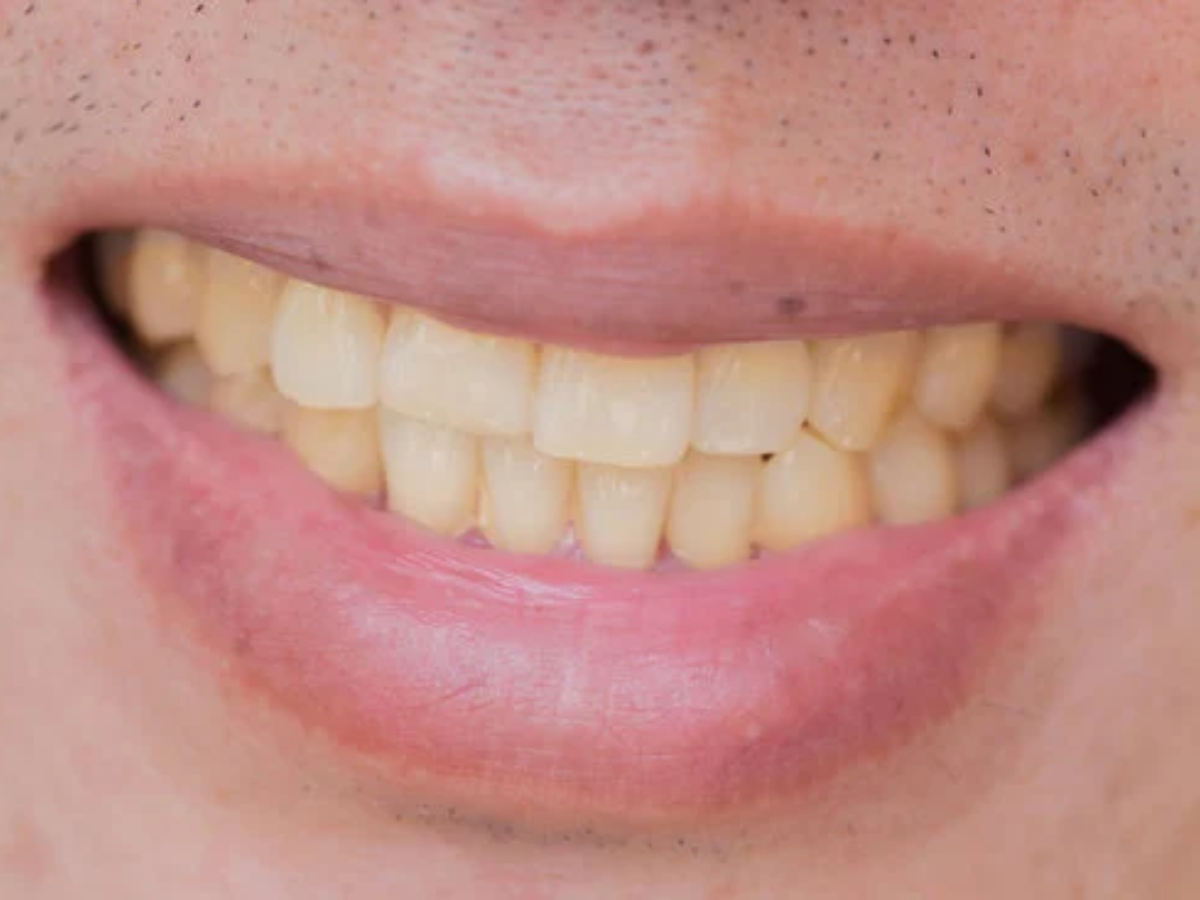 ¿Por qué se tiñen los dientes?