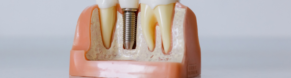 Infección de los implantes dentales