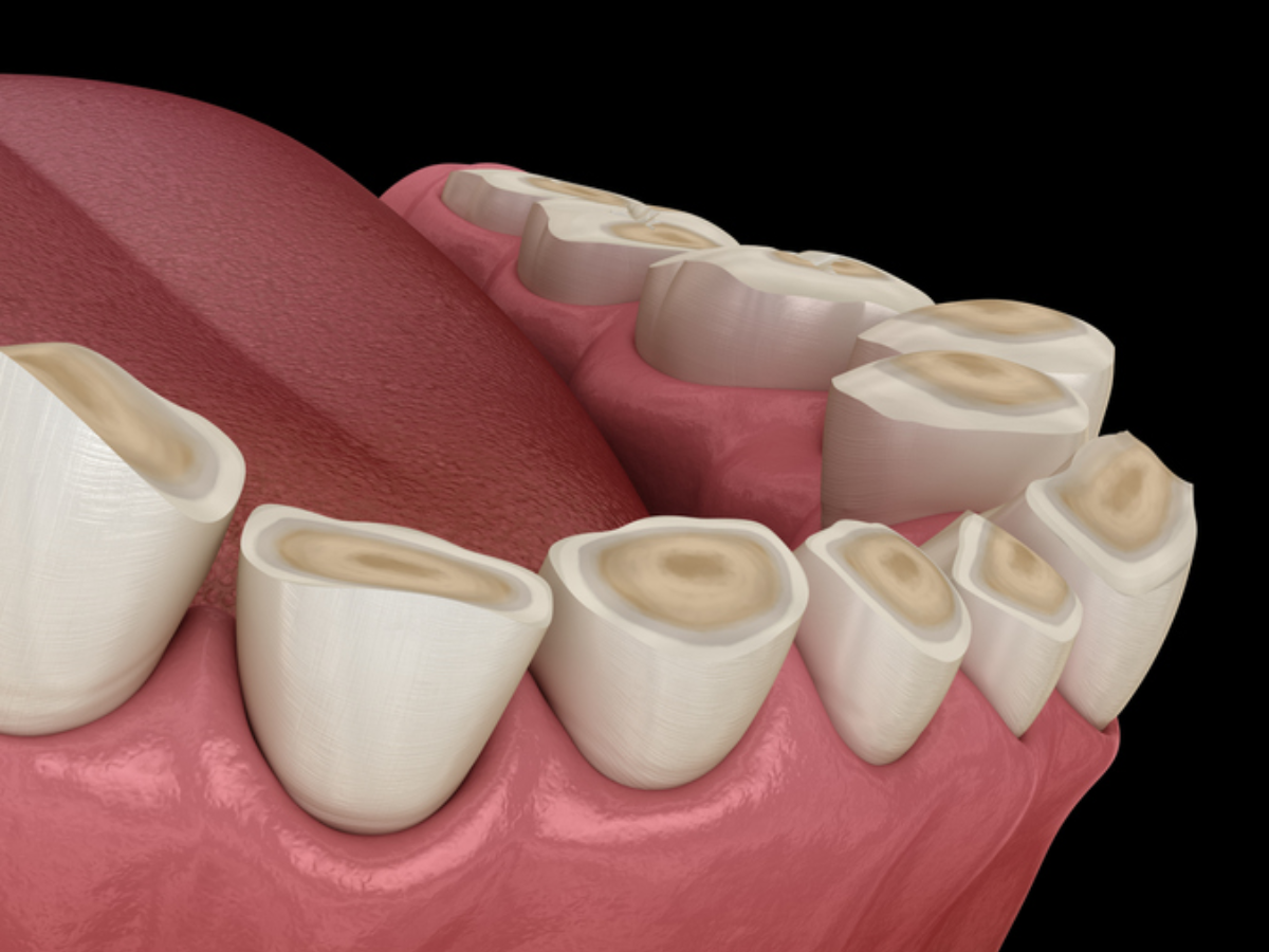 Erosión dental