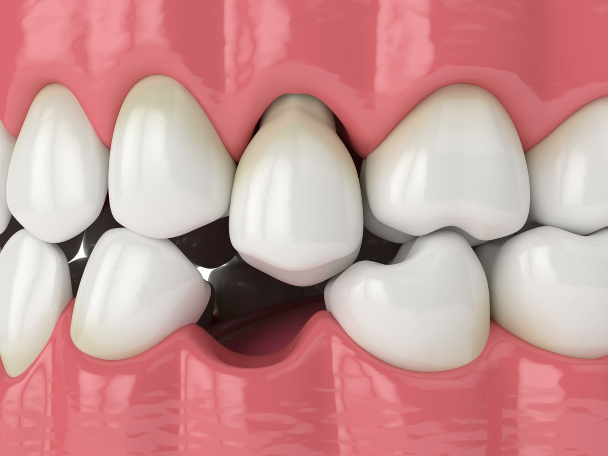 ¿Cómo reponer tus dientes?