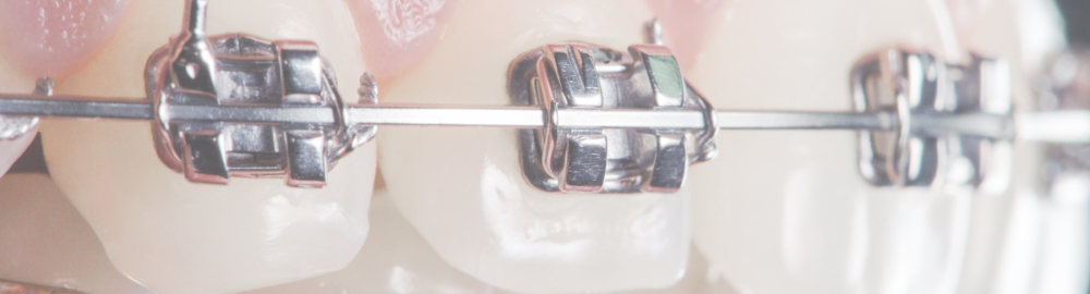 La preocupante realidad de la Ortodoncia Low Cost