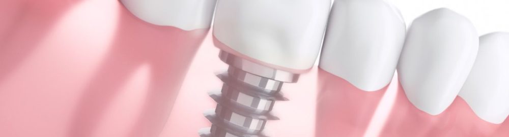 Periimplantitis: ¿Cuáles son los factores de riesgo?