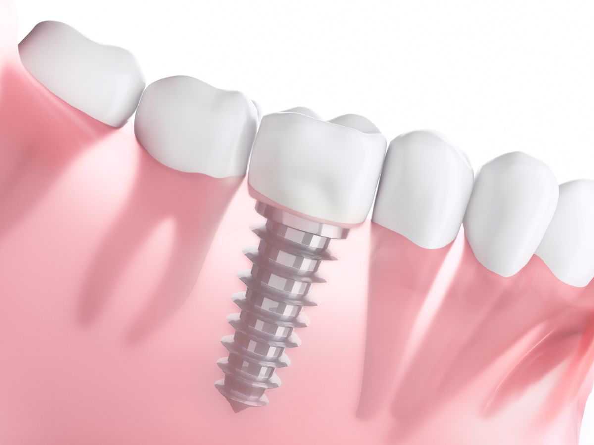 Periimplantitis: ¿Cuáles son los factores de riesgo?