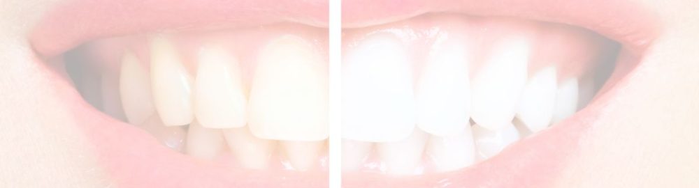 Los riesgos del blanqueamiento dental sin supervisión