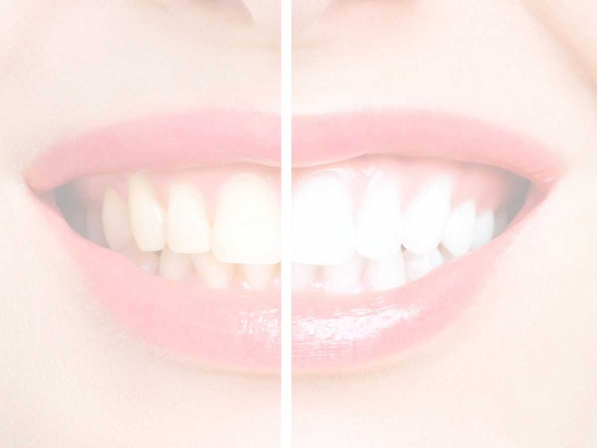 Los riesgos del blanqueamiento dental sin supervisión