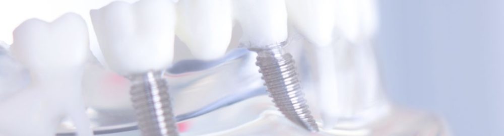 ¿Cuándo deberías valorar una prótesis dental?