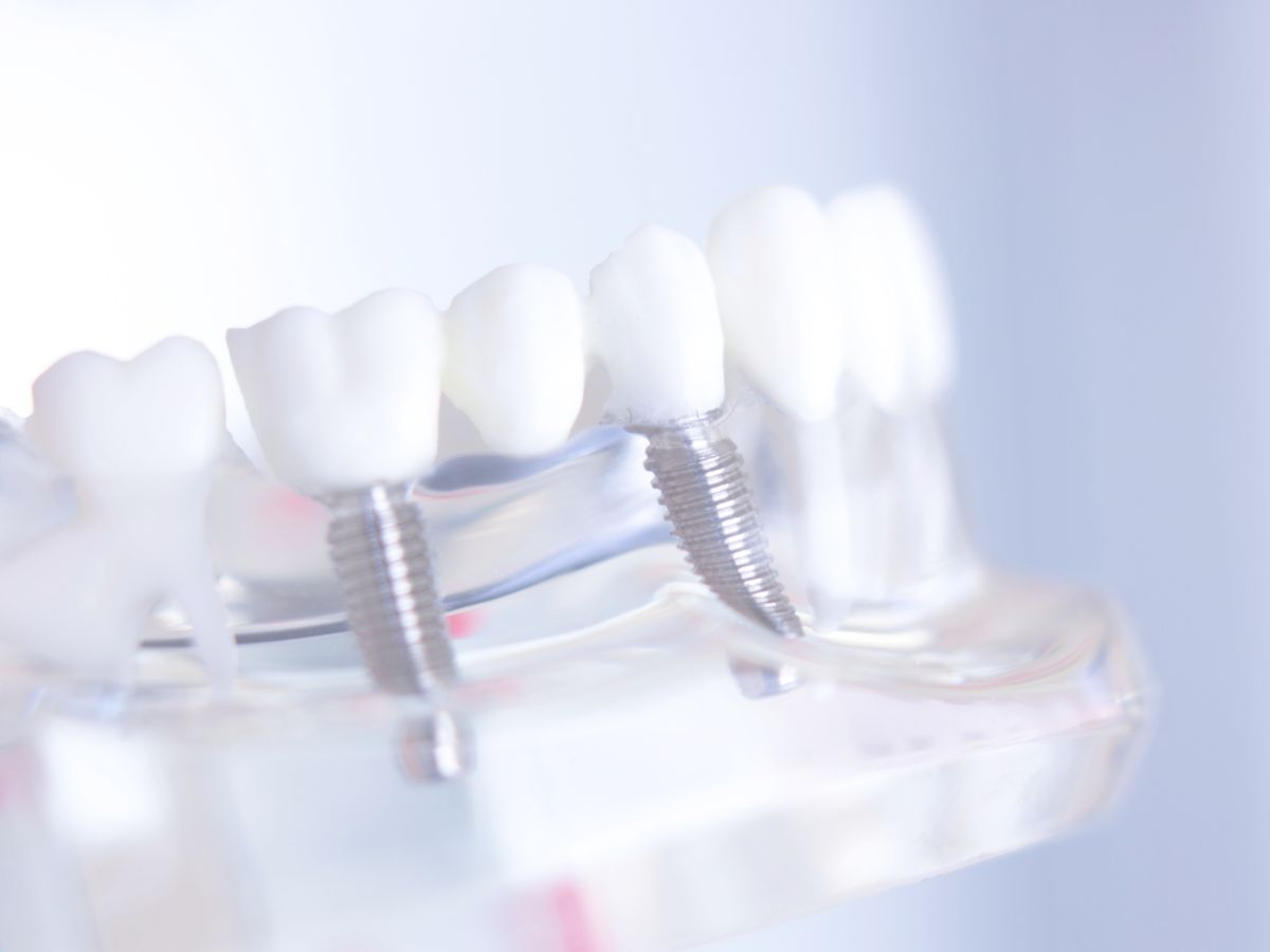 ¿Cuándo deberías valorar una prótesis dental?