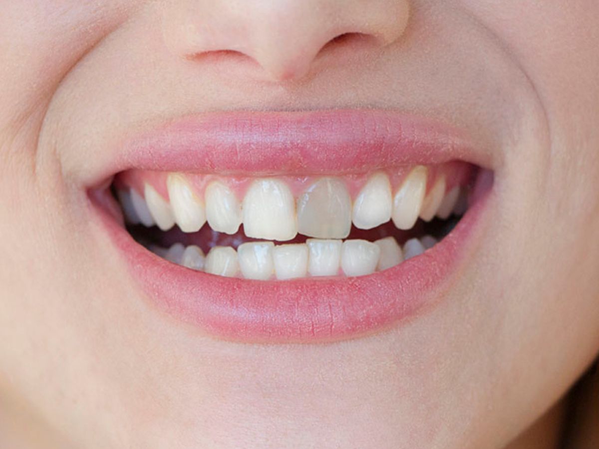 ¿Por qué se ponen los dientes grises? Causas y tratamientos en Pamplona