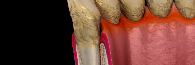 Piorrea (Periodontitis): Síntomas y tratamientos avanzados en Pamplona