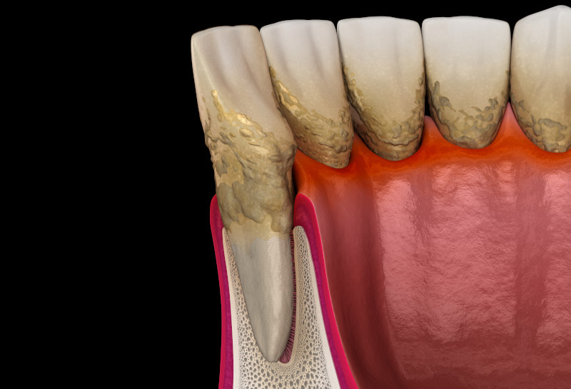 Piorrea (Periodontitis): Síntomas y tratamientos avanzados en Pamplona