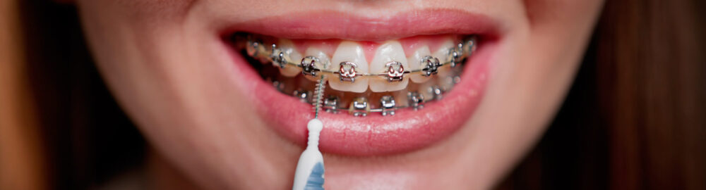 Cómo cuidar tu higiene dental durante la ortodoncia