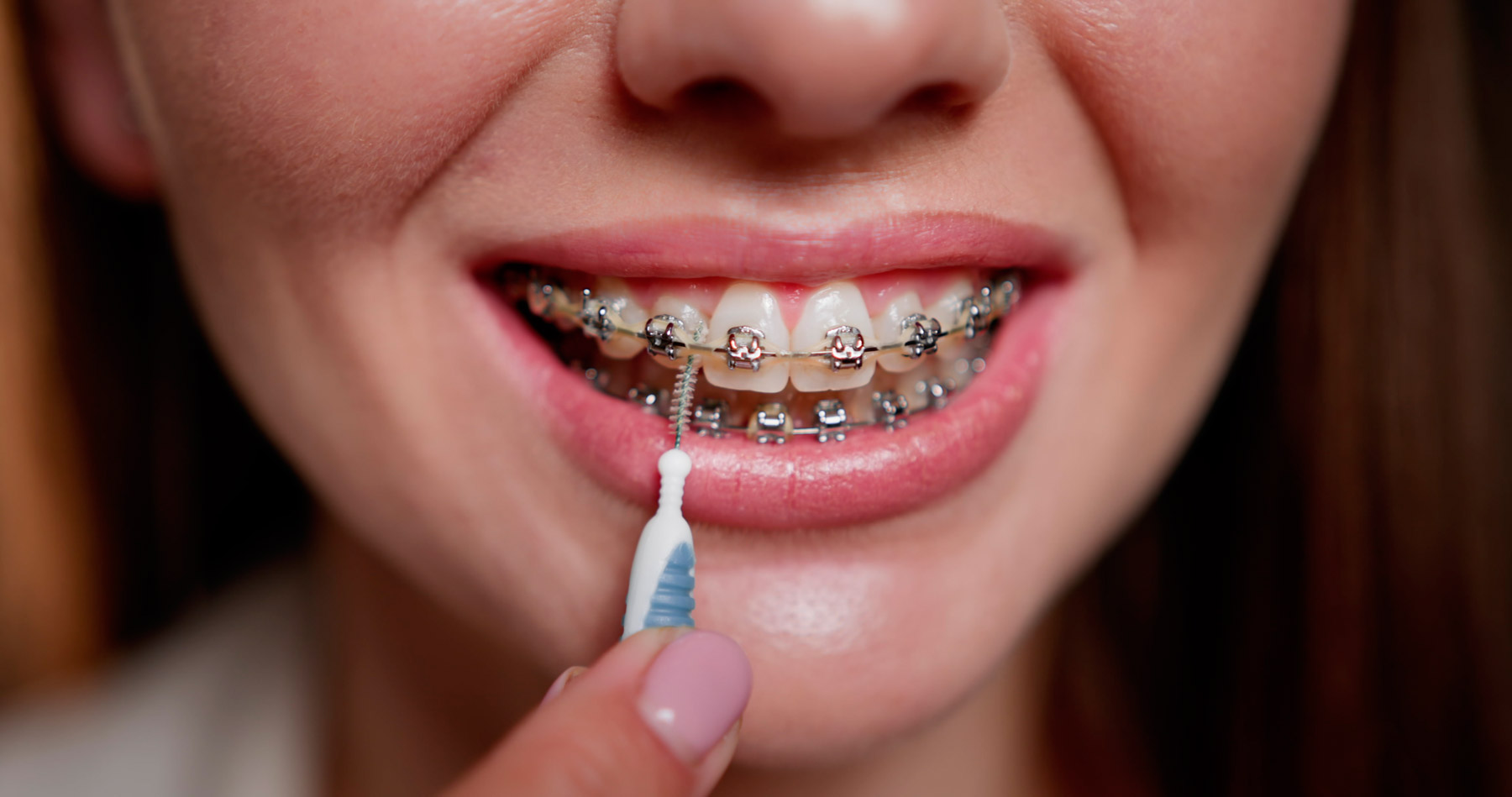 Cómo cuidar tu higiene dental durante la ortodoncia